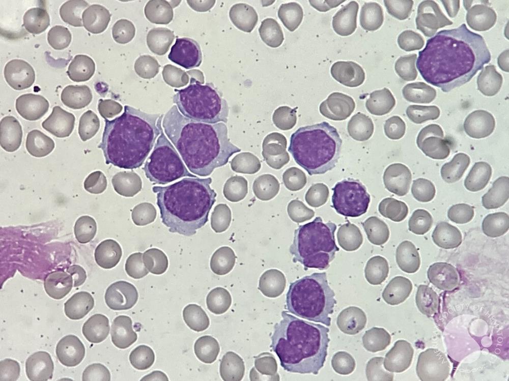 Mantle Cell Lymphoma | Image: Perla Vicari, MD, PhD, ASH Image Bank