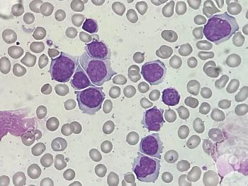 Mantle Cell Lymphoma | Image: Perla Vicari, MD, PhD, ASH Image Bank