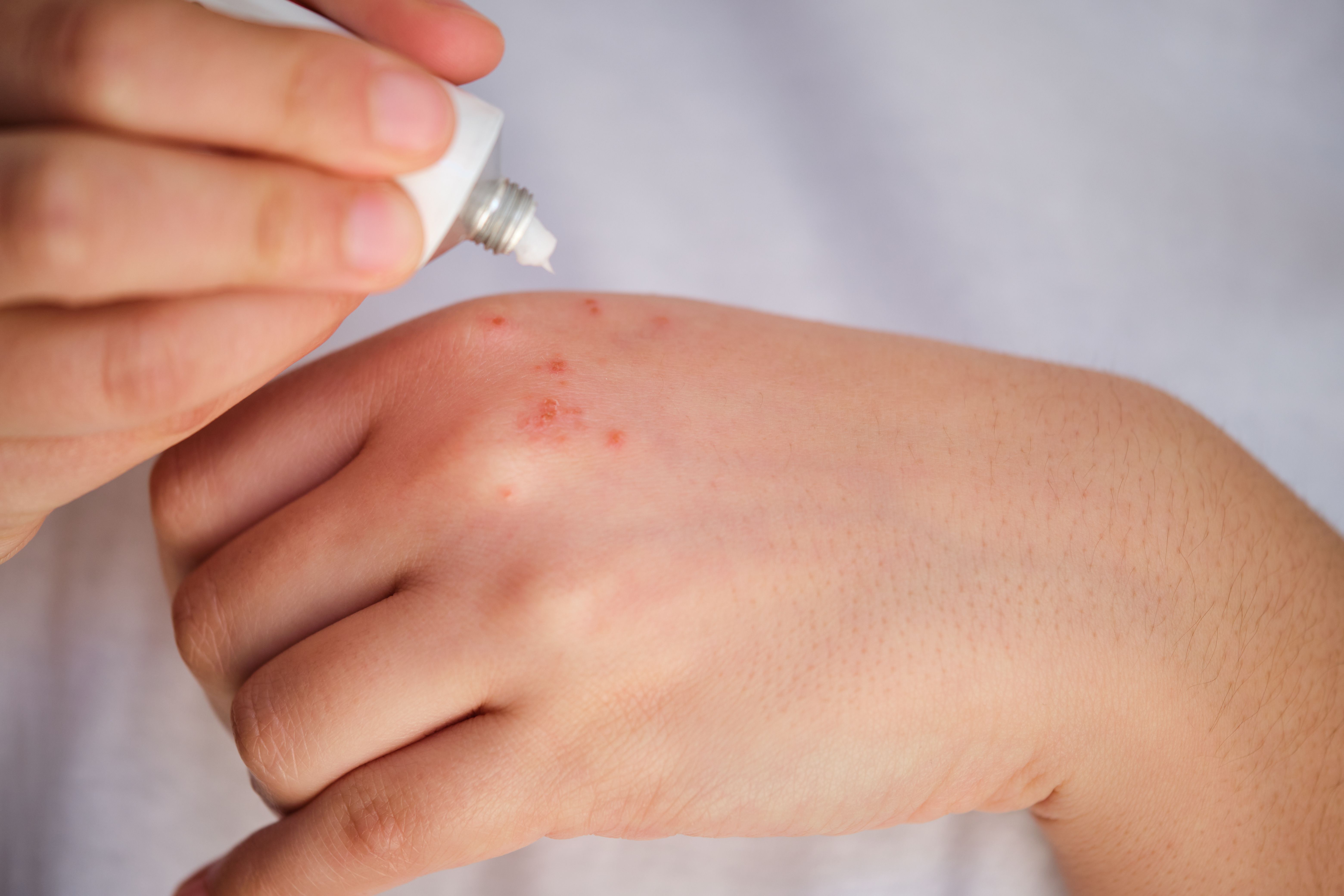 Topical cream for AD | Image credit: Ladanifer - stock.adobe.com