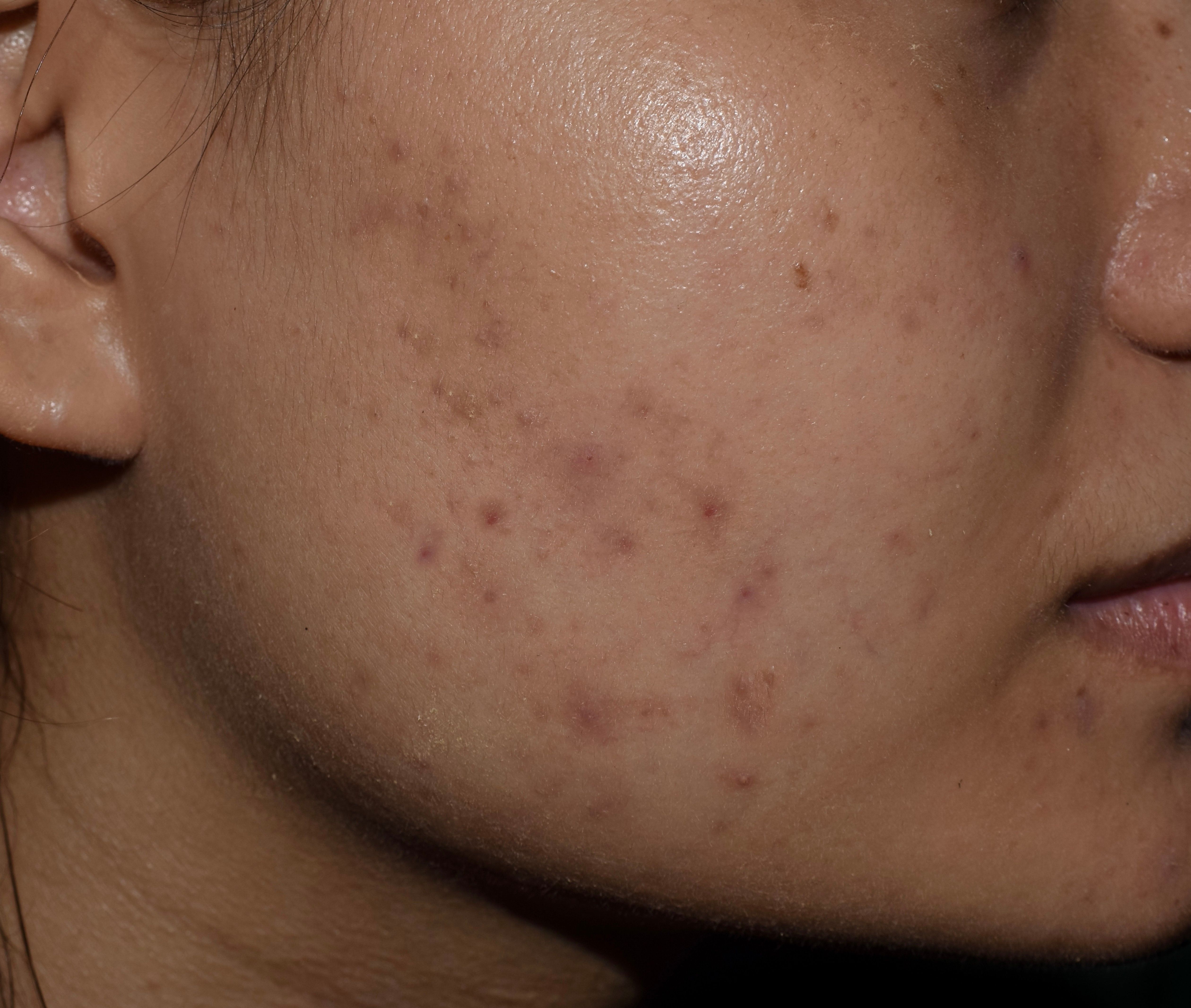 Acne scar | Image credit: ZAY WIN HTAI - stock.adobe.com