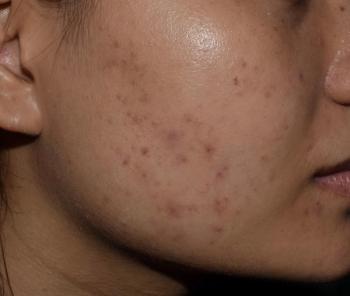 Acne scar | Image credit: ZAY WIN HTAI - stock.adobe.com