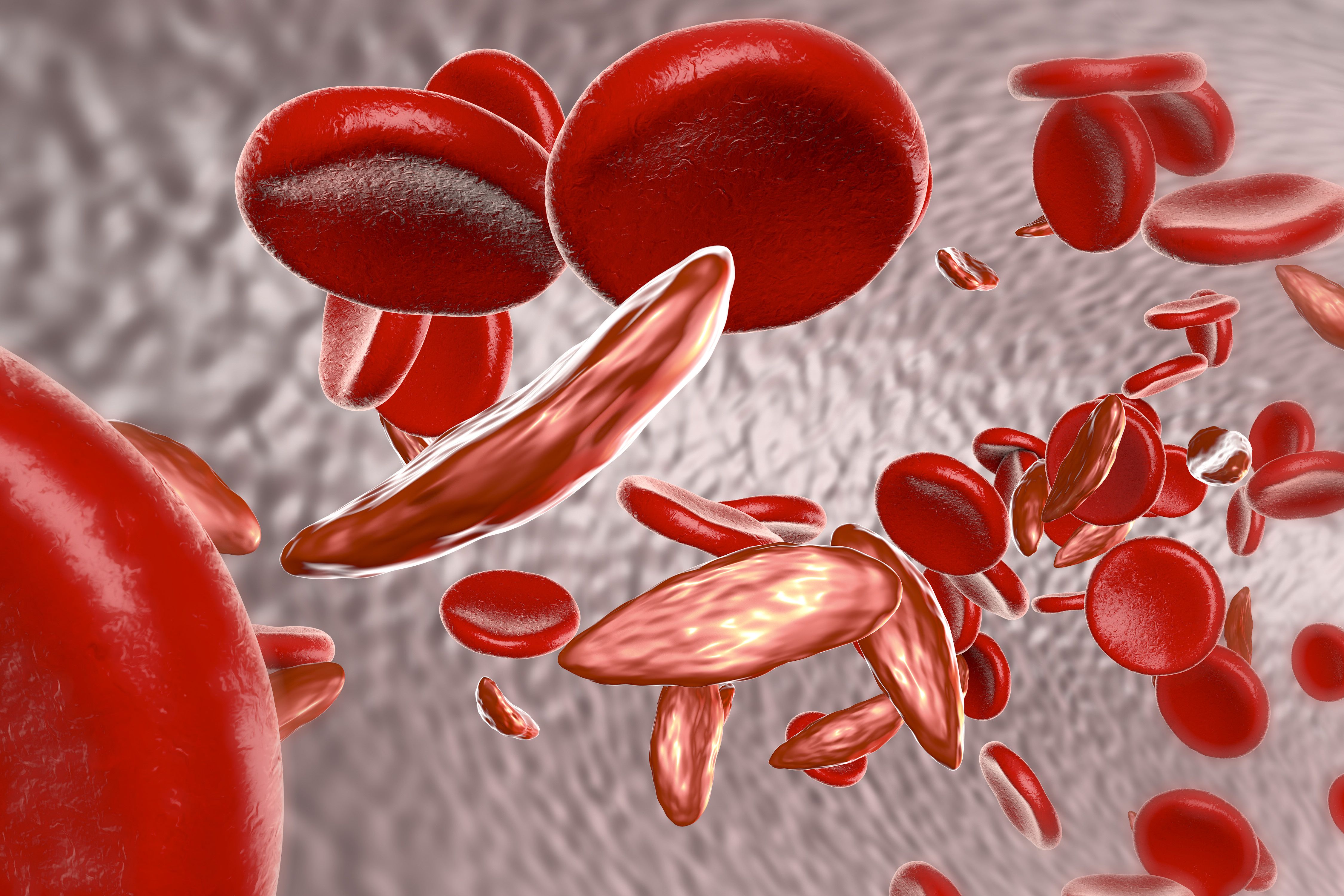 Rendering of sickle cell diseaes