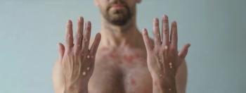 Monkeypox virus (mpox) | Image Credit: Halfpoint - stock.adobe.com
