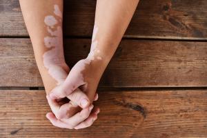 Hands with vitiligo on a table | Image Credit: © Liga Cerina - stock.adobe.com