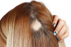 Emerging research suggests alopecia areata and atopic dermatitis share overlapping immune pathways that may support more targeted, cross-disease treatment strategies.