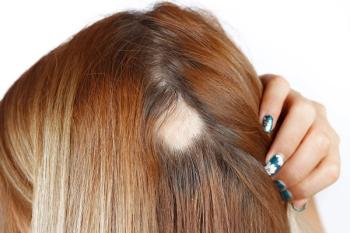 Emerging research suggests alopecia areata and atopic dermatitis share overlapping immune pathways that may support more targeted, cross-disease treatment strategies.