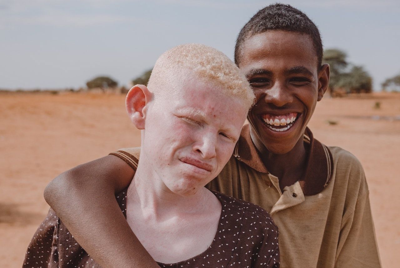 Albino African People albino-african-people