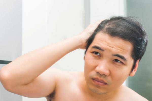 Asian male with hair loss. | Image Credit: canjoena - stock.adobe.com .jpeg