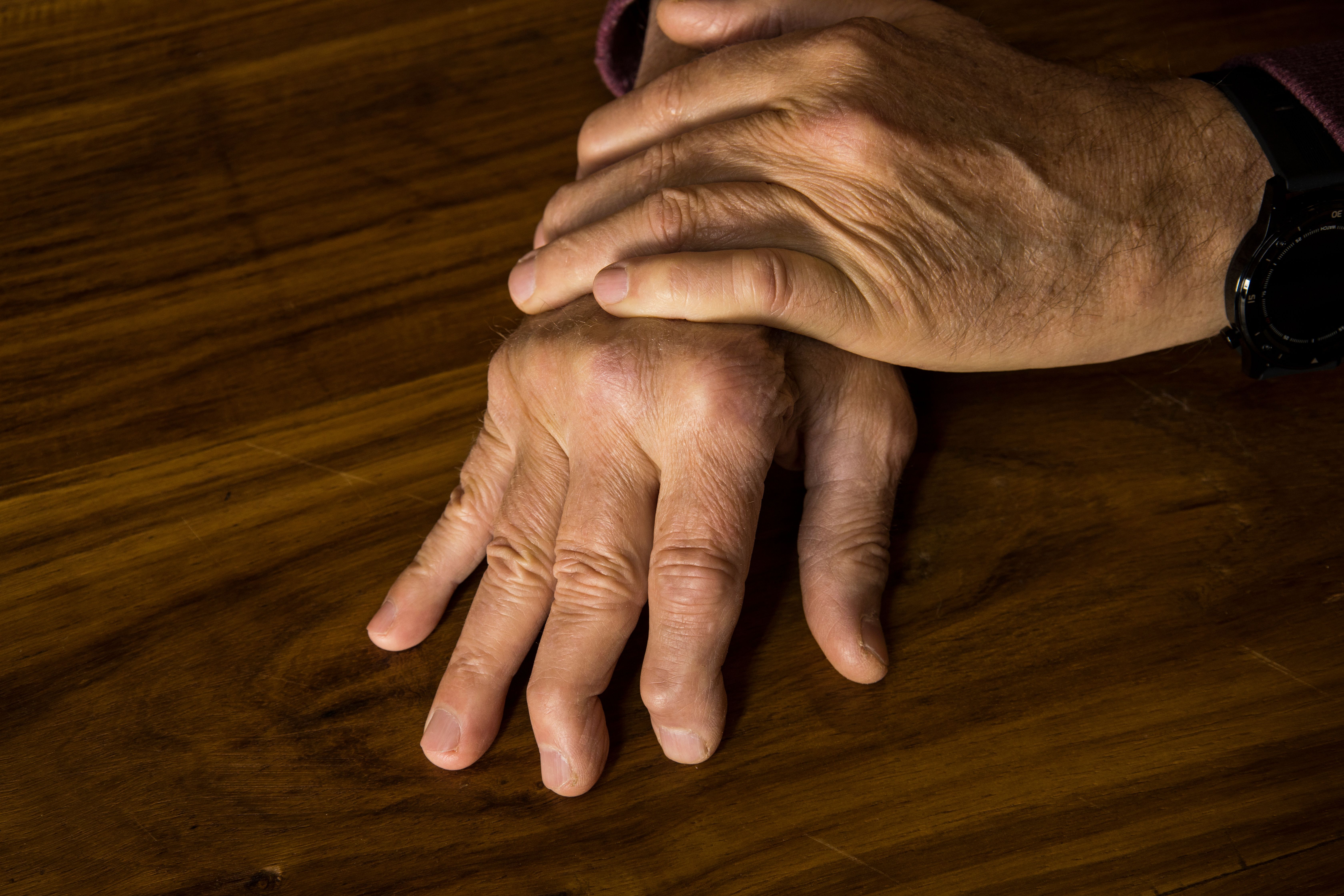 Hands of patient with psoriatic arthritis | Image Credit: Jacques Hugo - stock.adobe.com