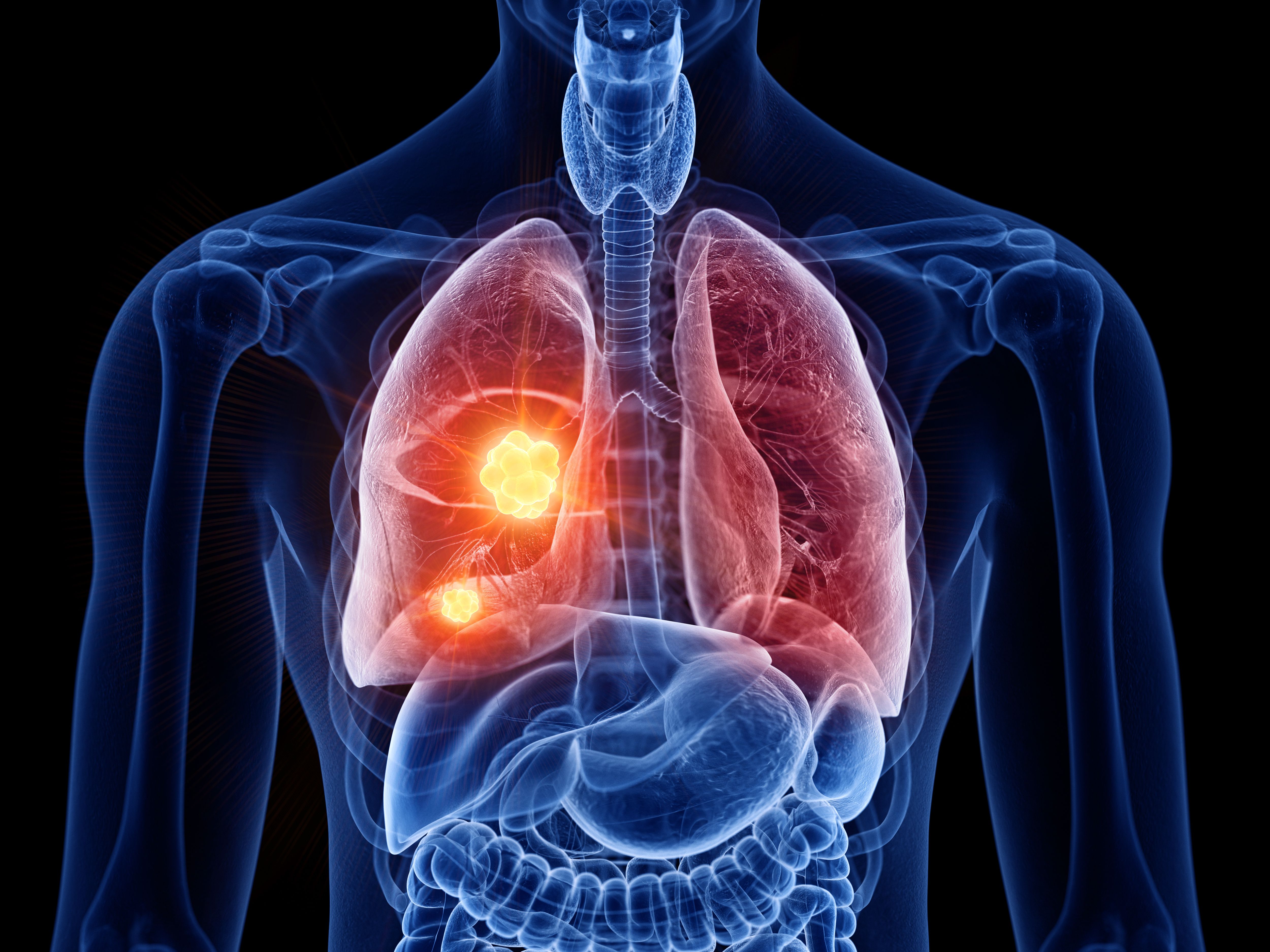 Lung cancer | Image credit: Sebastian Kaulitzki - stock.adobe.com