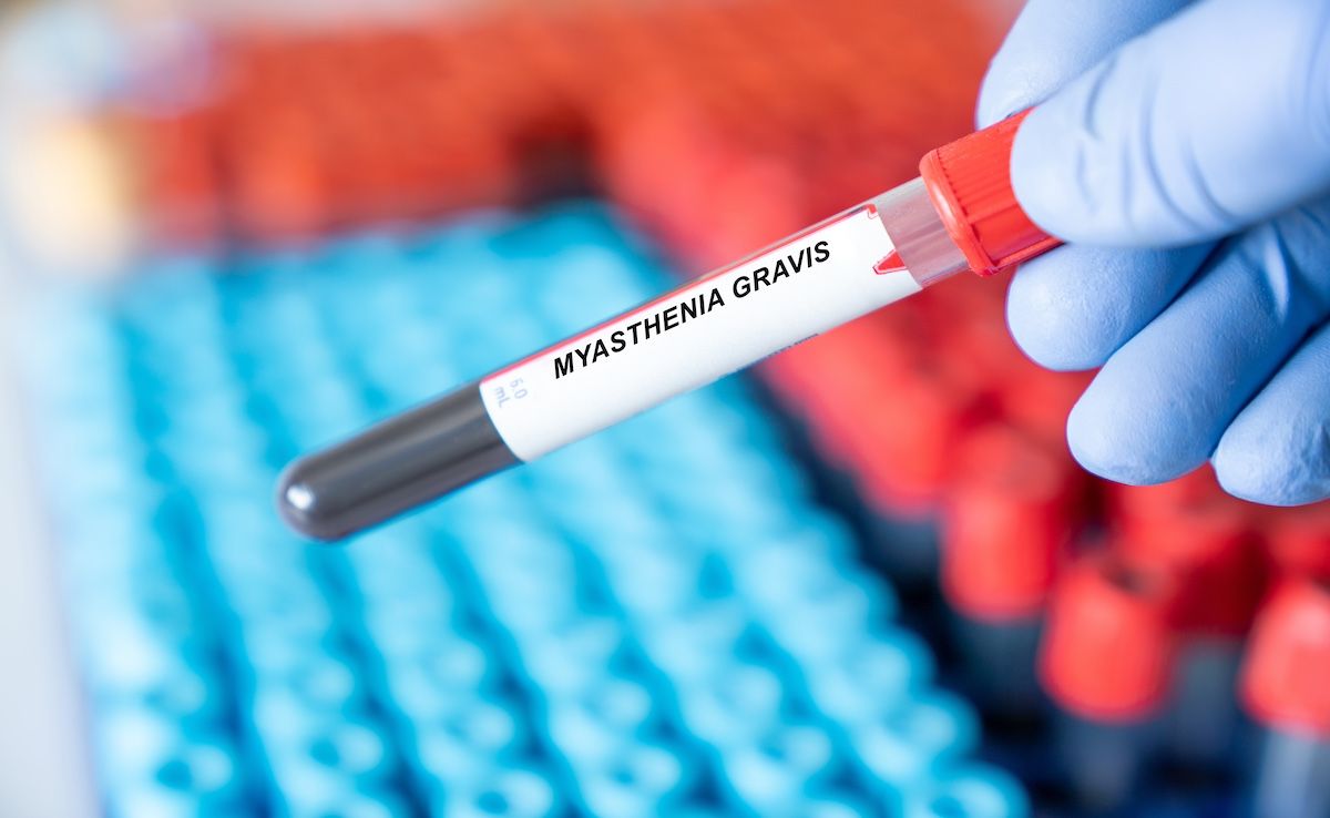 AChR-Ab titers and the AChR-Ab rates of change correlated with myasthenia gravis disease severity scores in a recent study. | Image credit: luchschenF - stock.adobe.com