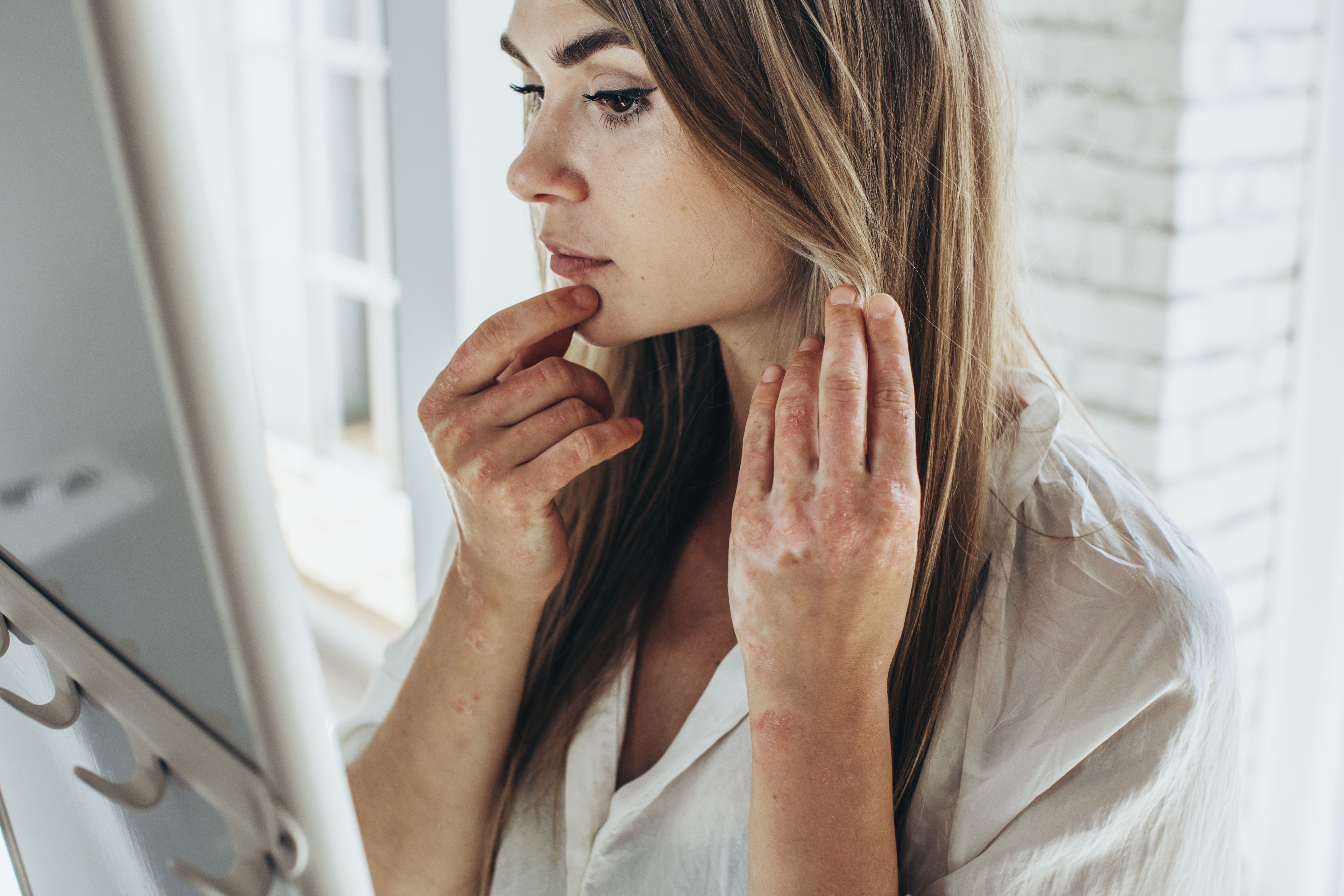 Psoriasis. Acute psoriasis on the knees, body, elbows is an autoimmune, incurable dermatological skin disease | nuzza11 - stock.adobe.com