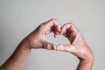 Vitiligo. | Image Credit: JoseManuel - stock.adobe.com