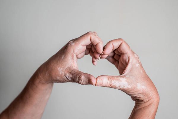Vitiligo. | Image Credit: JoseManuel - stock.adobe.com