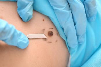 Clinician Marking Non-melanoma Skin Cancer Lesion for Removal | image credit: Pixel-Shot - stock.adobe.com