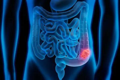 La obesidad visceral se asocia con fuga anastomótica después de la cirugía de cáncer de colon