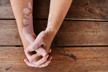 Investigators noted that the combination of upadacitinib and ruxolitinib achieved higher repigmentation rates than prior monotherapy trials. | Image Credit: Liga Cerina - stock.adobe.com 
