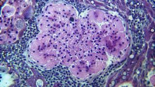 Navigating Perioperative Immunotherapy Decisions in Lung Cancer Care: Jonathan Thompson, MD, MS