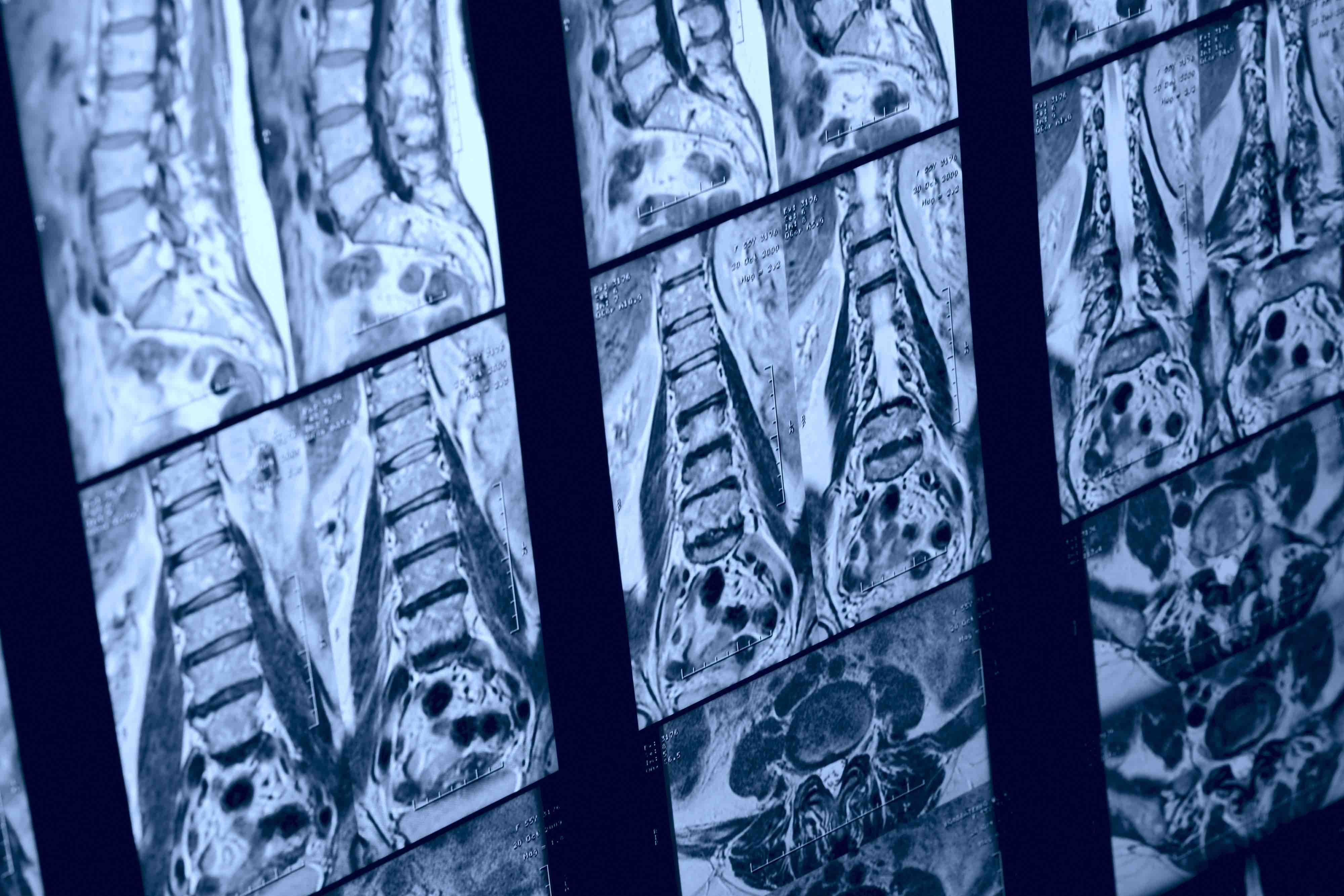 Spine MRI - Kondor83 - stock.adobe.com