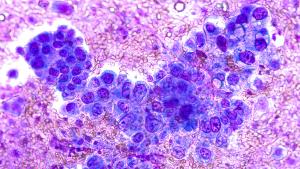 Expanding the Role of NGS and Retesting in Early and Refractory NSCLC: Jonathan Thompson, MD, MS
