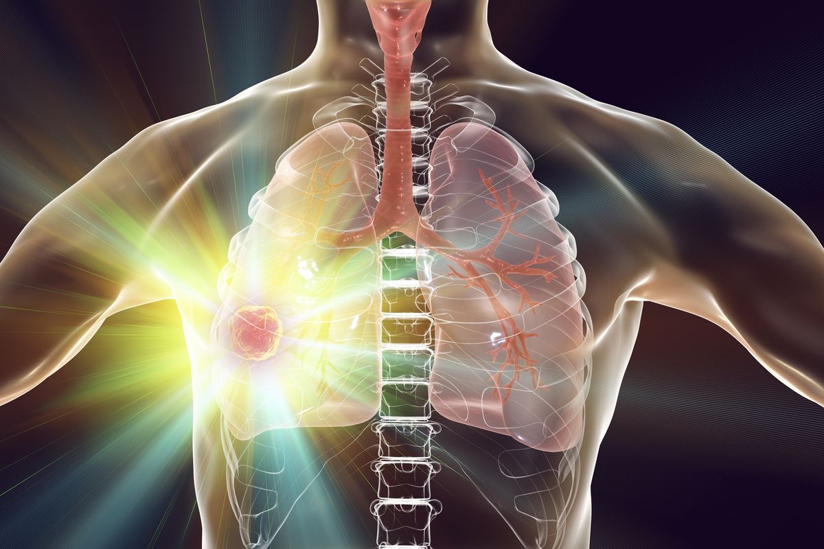 Chemotherapy Plus Cemiplimab Improves QOL vs Chemotherapy Alone in NSCLC