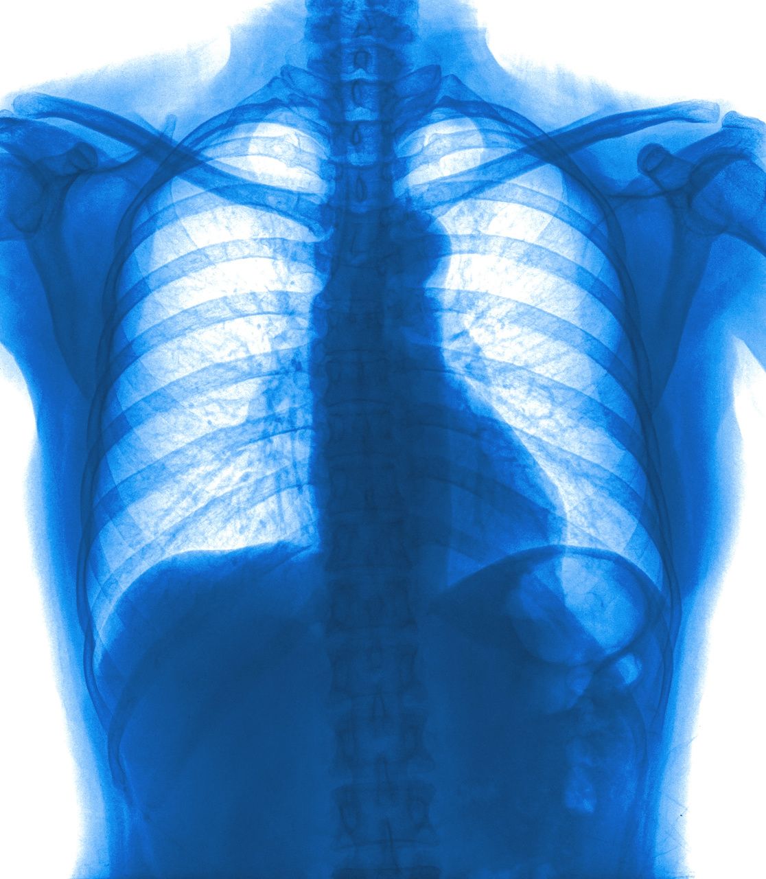 Poor Nutritional Status Affects Quality of Life for Patients With COPD