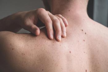 Image of patient with irritated skin