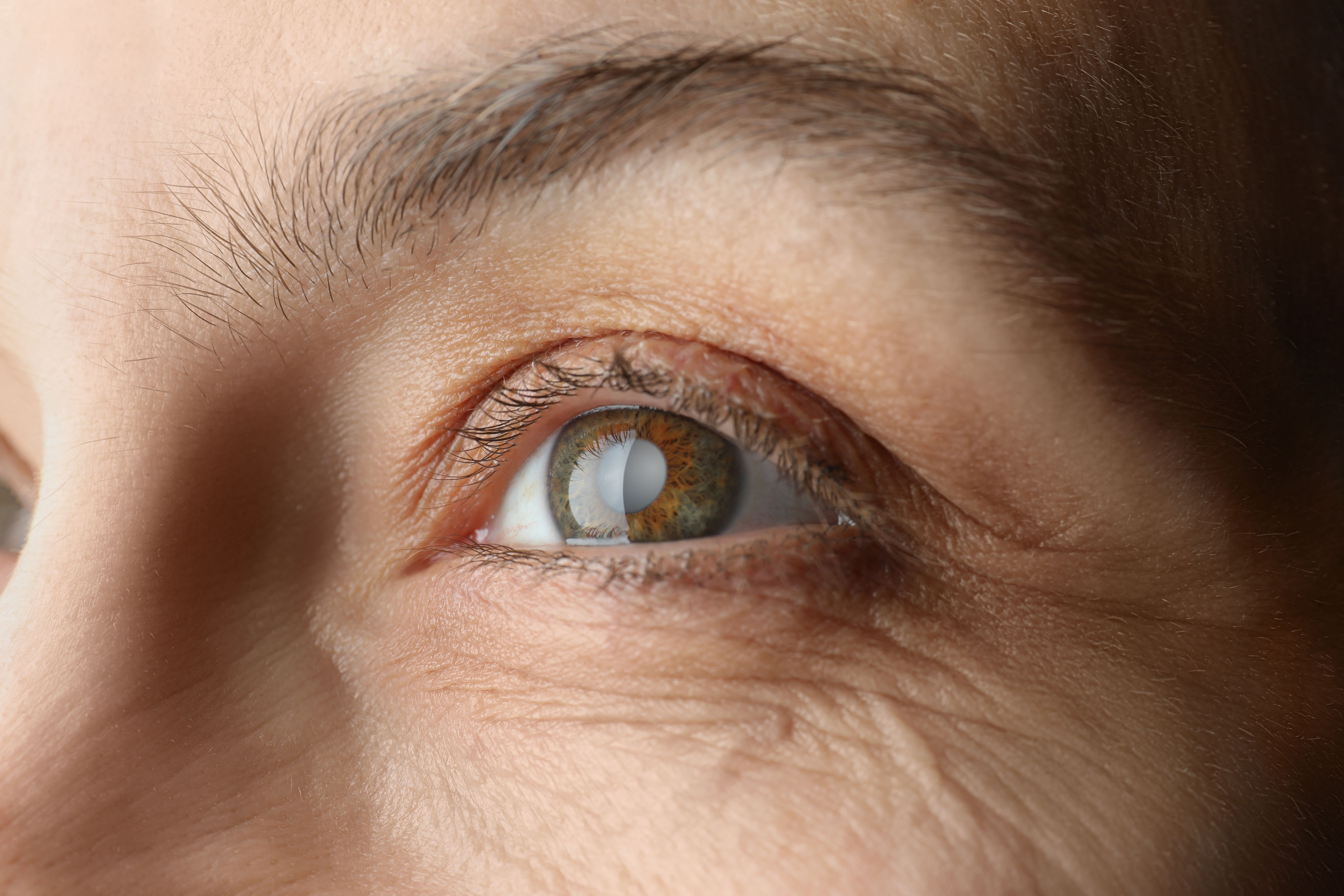 Woman with eye condition | Image credit: New Africa - stock.adobe.com
