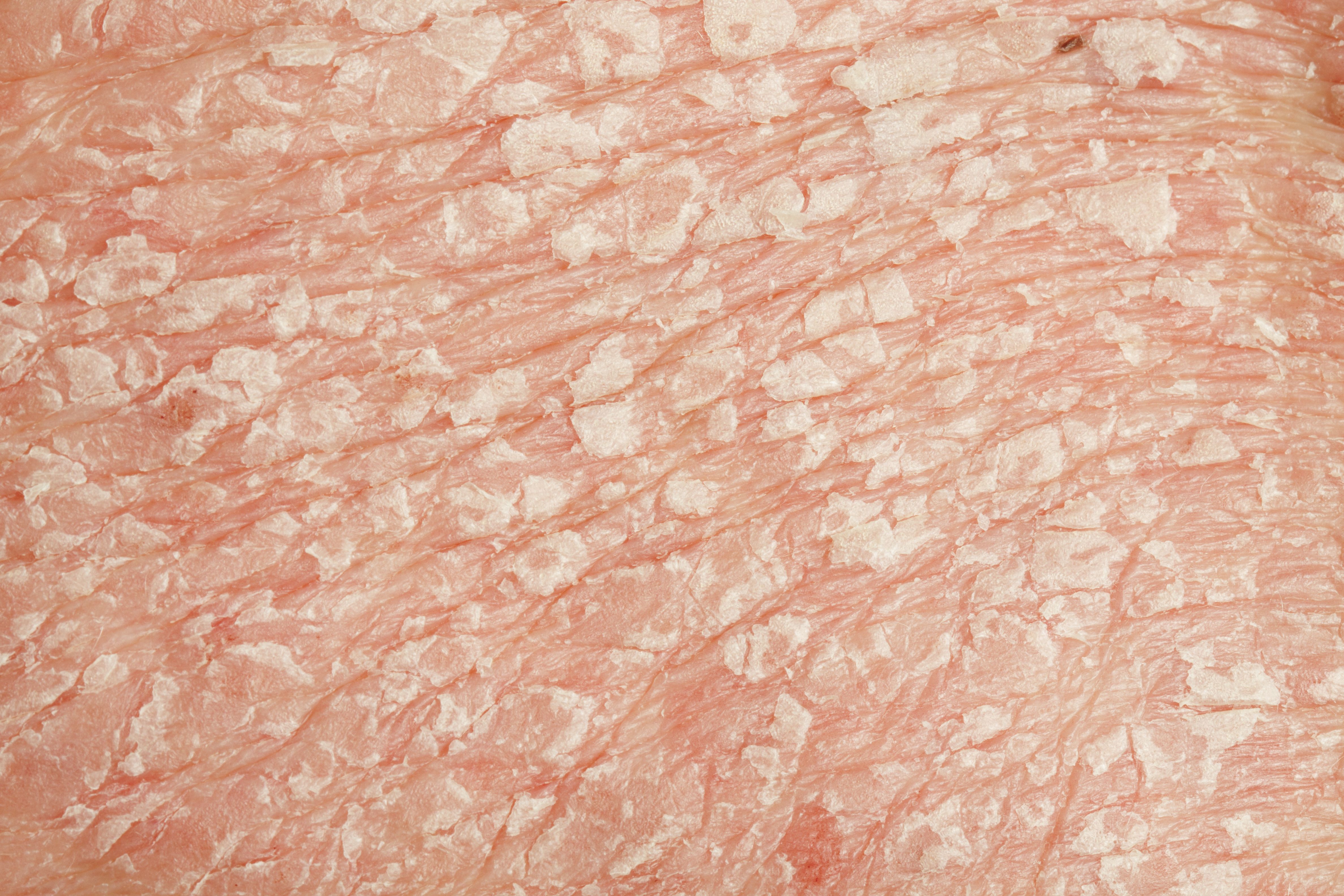 image of psoriasis