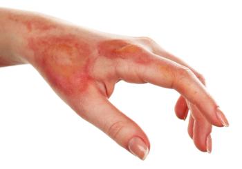 Burn scar | Image Credit: Africa Studio - stock.adobe.com