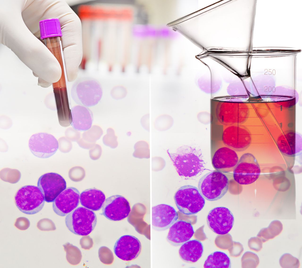 At Increasing Levels of Sensitivity, NGS-MRD Detects CLL in Bone Marrow