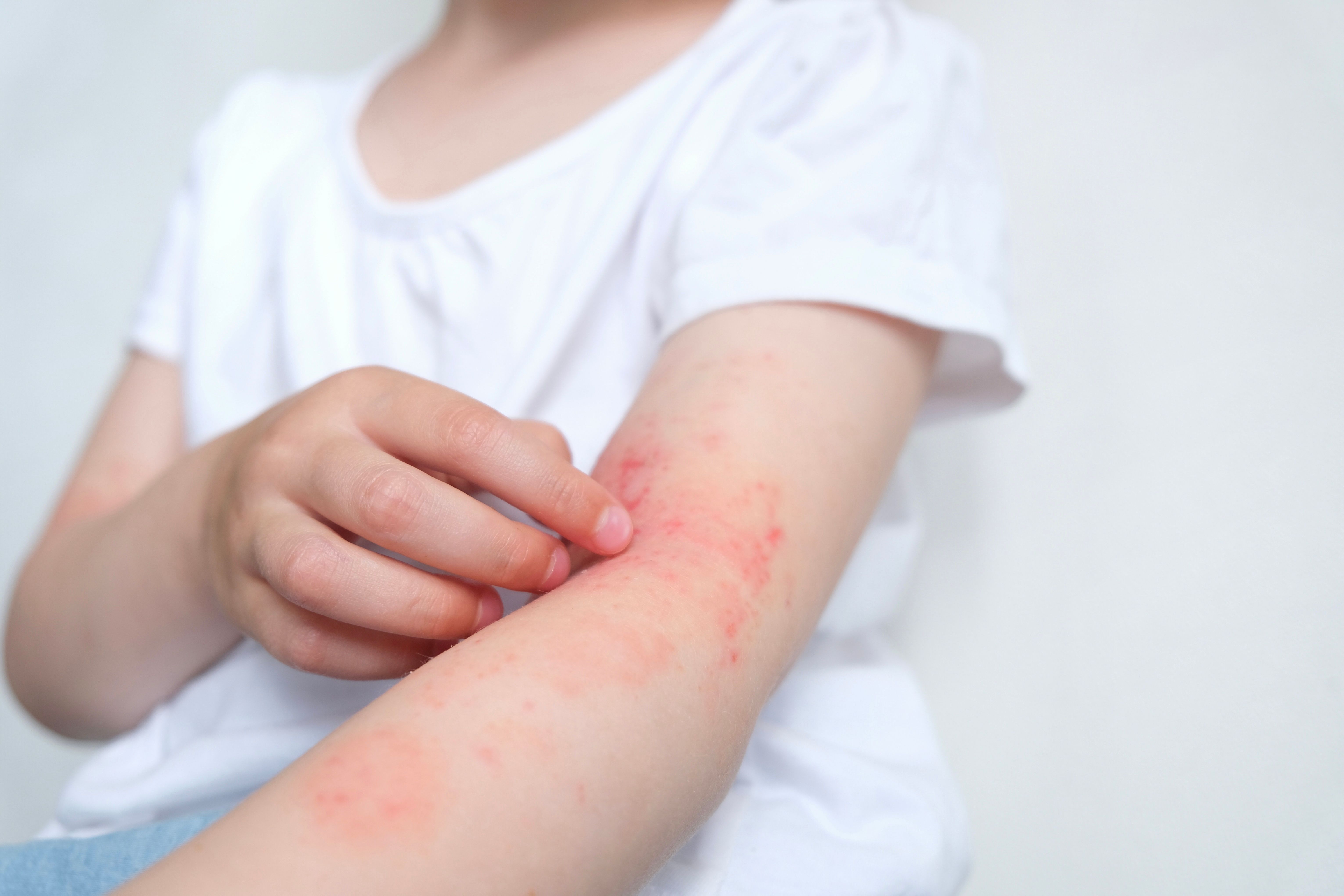 Using Biologic Therapies Safely in Pediatric Patients With Skin Conditions