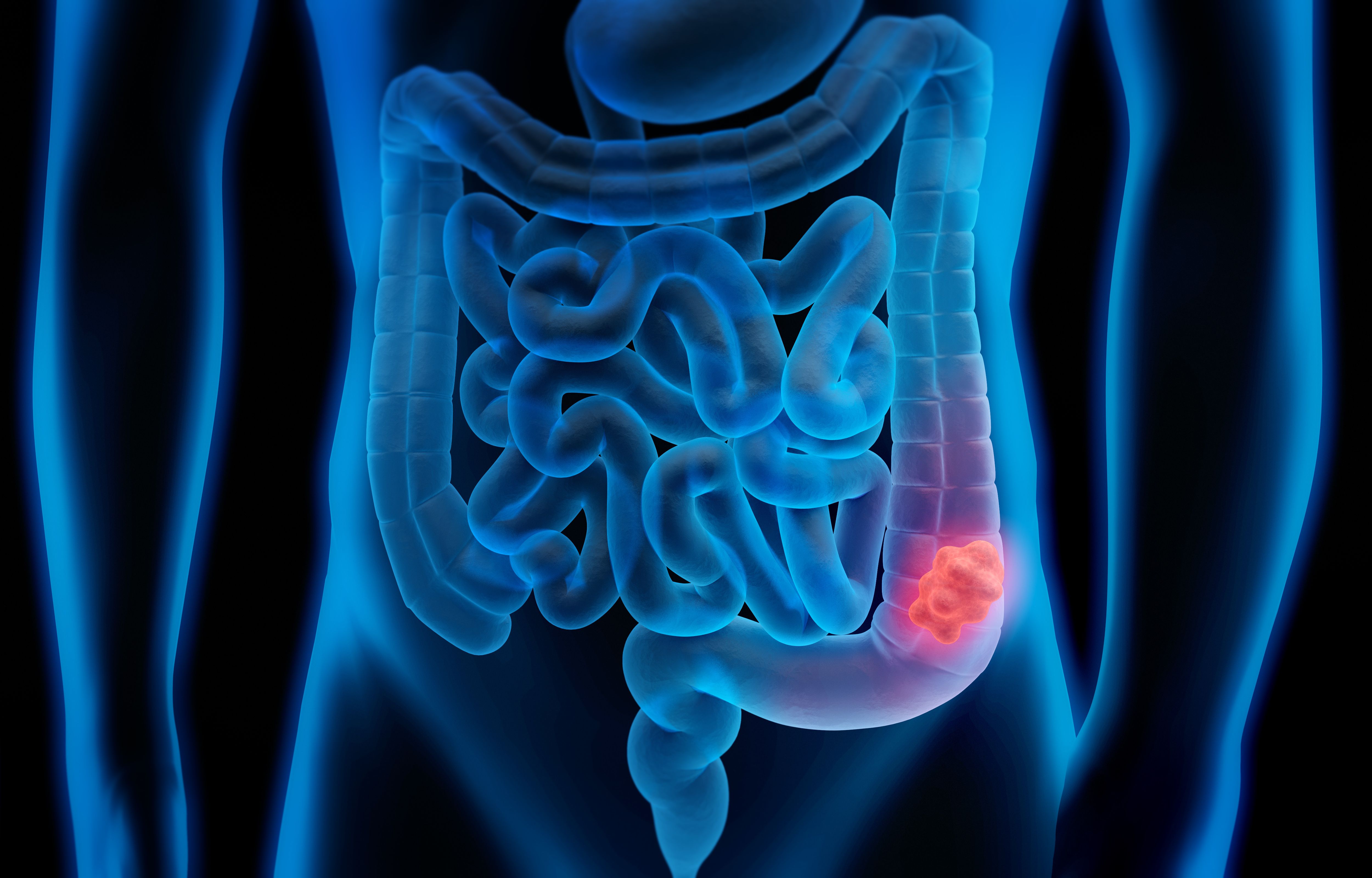 Colorectal cancer | Image credit: peterschreiber.media - stock.adobe.com