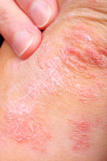 patient with psoriasis flare.