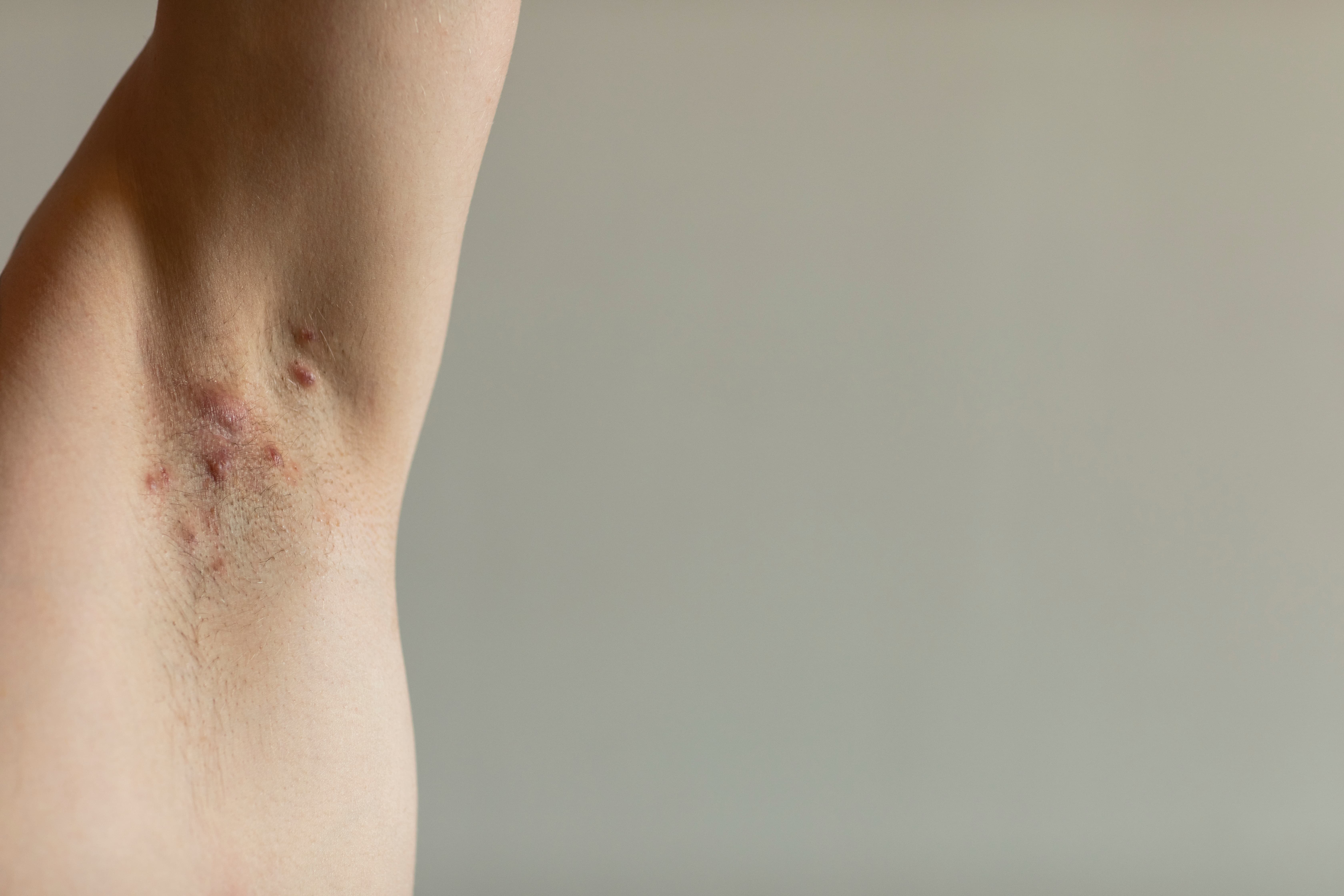 Hidradenitis images | © Adobe Stock