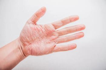 The DELTA 3 findings support delgocitinib as a durable therapeutic option for moderate-to-severe chronic hand eczema. | Image credit: traza - stock.adobe.com