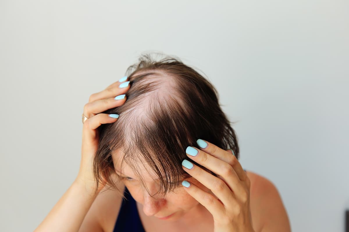 Though it would seem surprising for alopecia therapies with overlapping targets to lead to different patient outcomes, the authors said the evidence suggests the strategy can work. | Image credit: Nadya Kolobova - stock.adobe.com