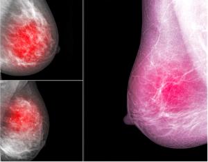 Mammography Screening Improves Outcomes Among African American and White American Patients With TNBC