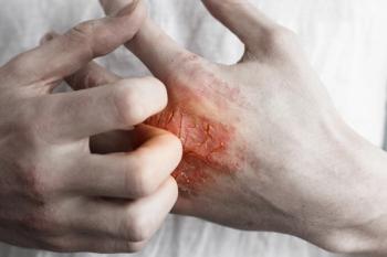 atopic dermatitis
