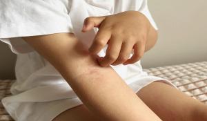 Pediatric skin irritation | Image Credit: © Ari-stock.adobe.com