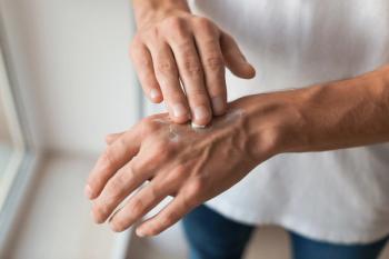 topical delgocitinib vs injectable dupilumab in CHE | Image credit: New Africa - stock.adobe.com