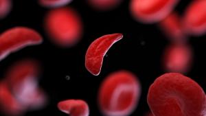 Experts discuss sickle cell disease subtypes, evolving therapies, and persistent barriers to equitable treatment access. | Image credit: @Sebastian Kaulitzki_adobestock.jpeg