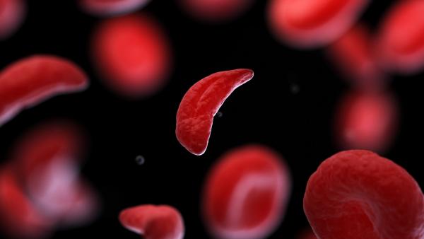 Experts discuss sickle cell disease subtypes, evolving therapies, and persistent barriers to equitable treatment access. | Image credit: @Sebastian Kaulitzki_adobestock.jpeg