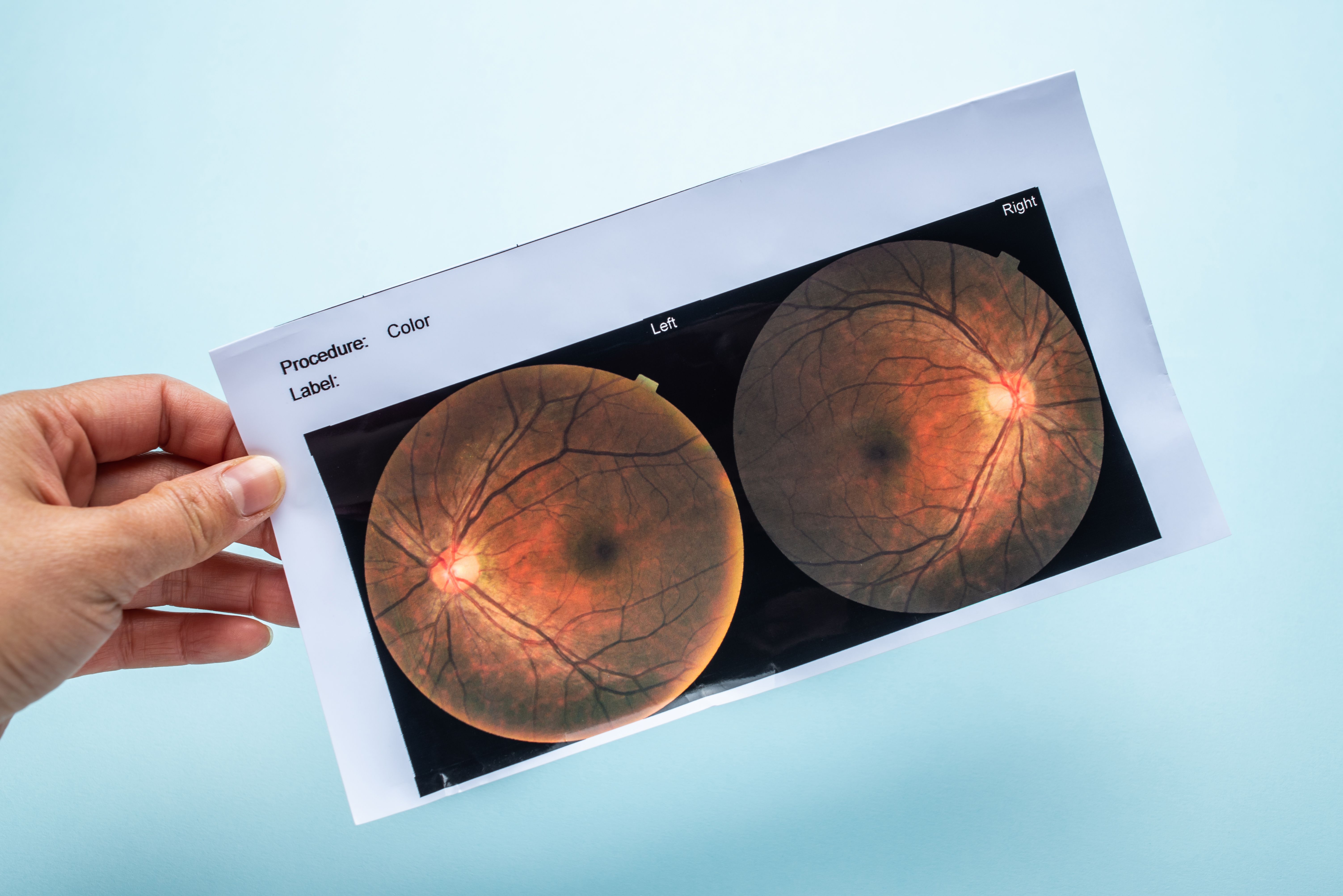 Fundus Photo | Image credit: WR.LILI - stock.adobe.com