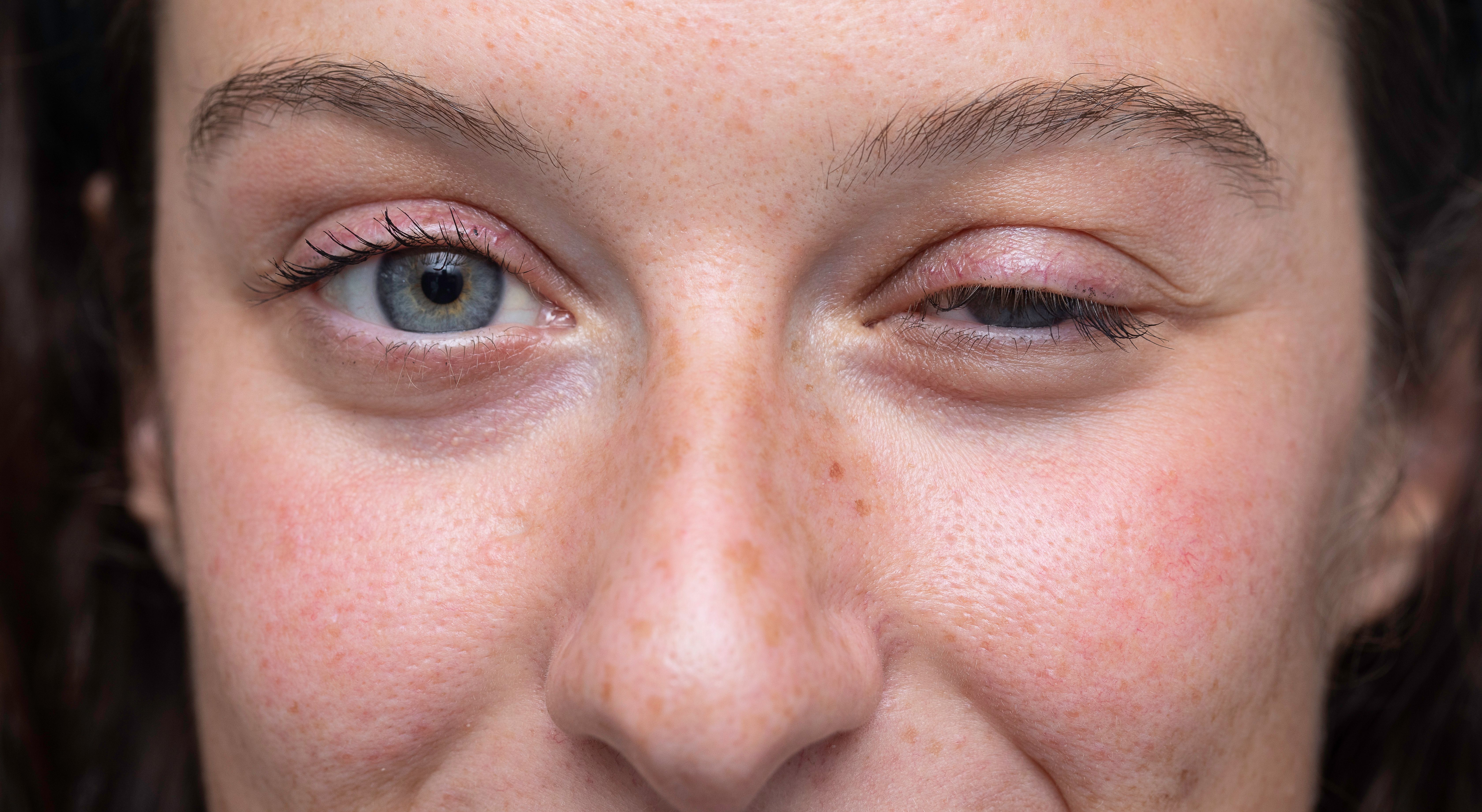 Ocular myasthenia gravis | Image credit: Alessandro Grandini - stock.adobe.com