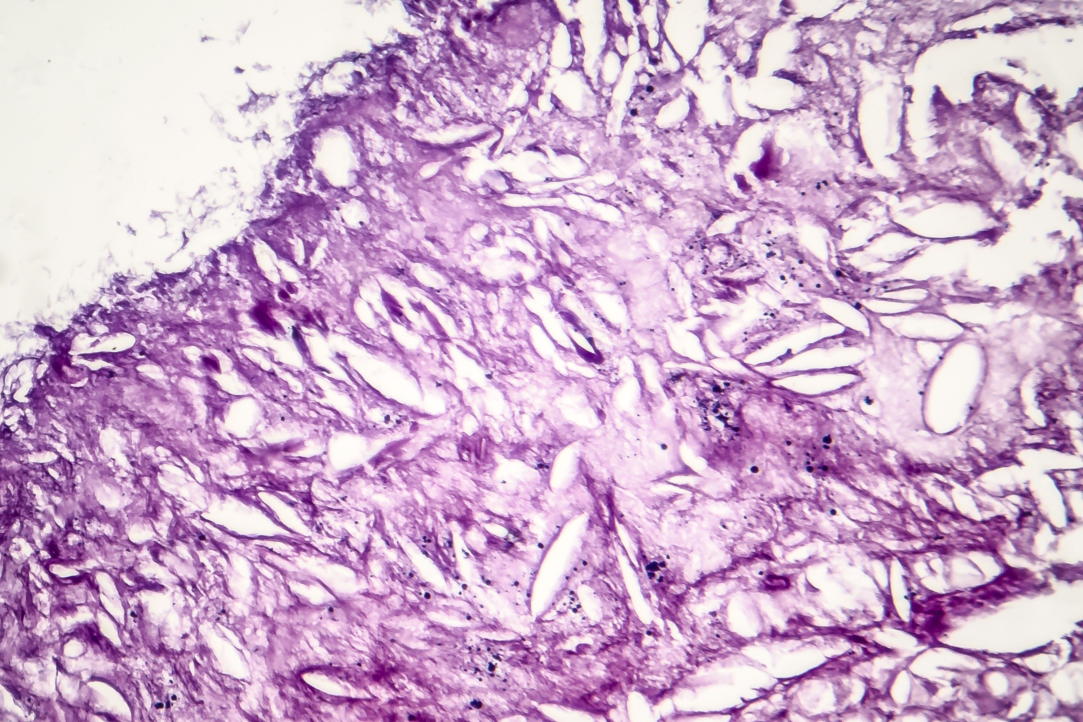 Graphic of melanoma