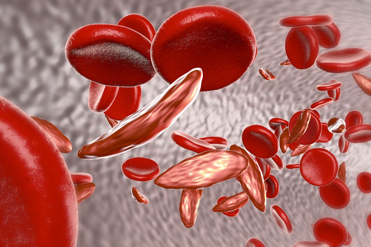 Sickle cells