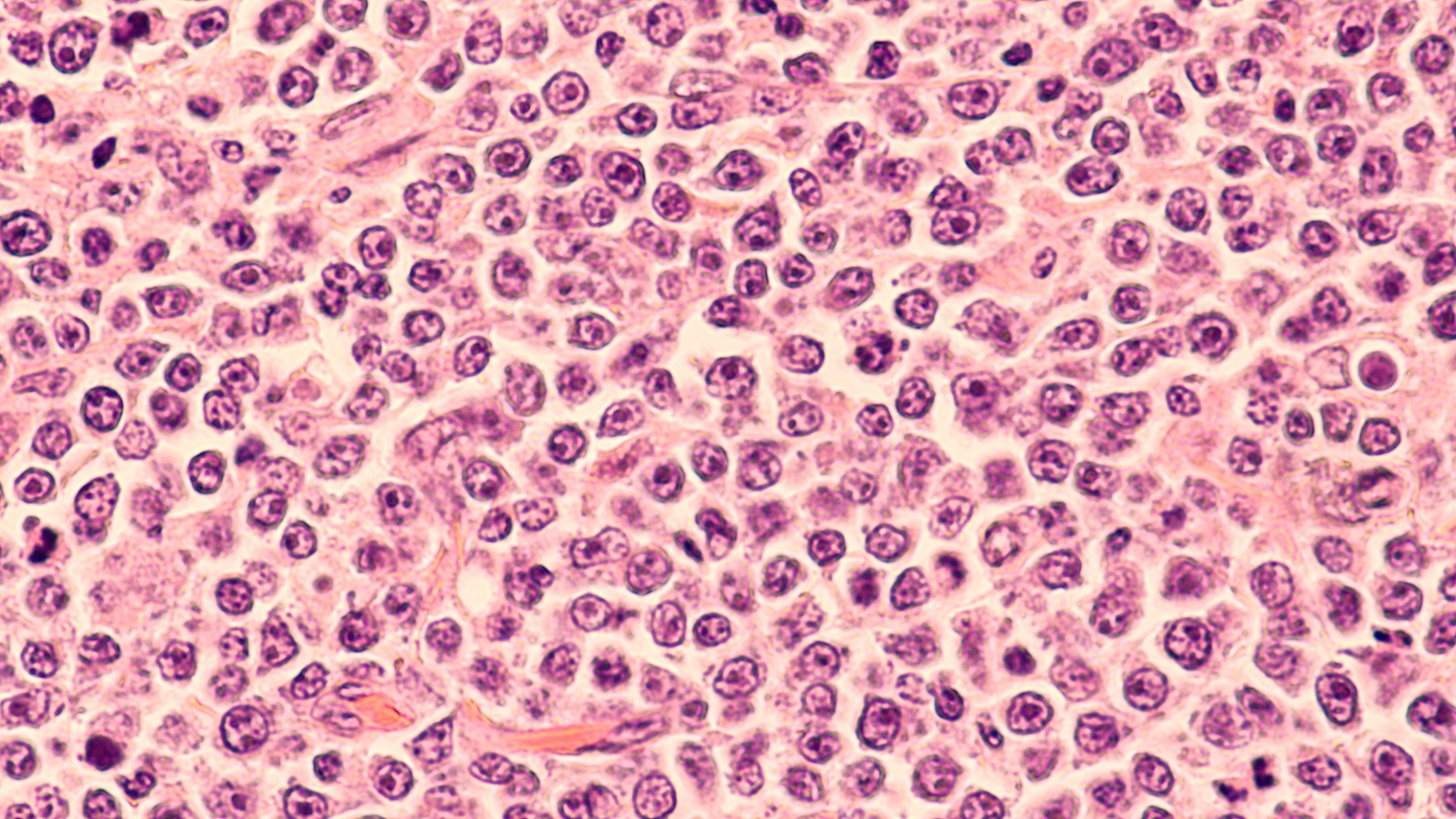 DLBCL | Image: David Litman / AdobeStock