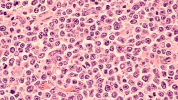 DLBCL | Image: David Litman / AdobeStock