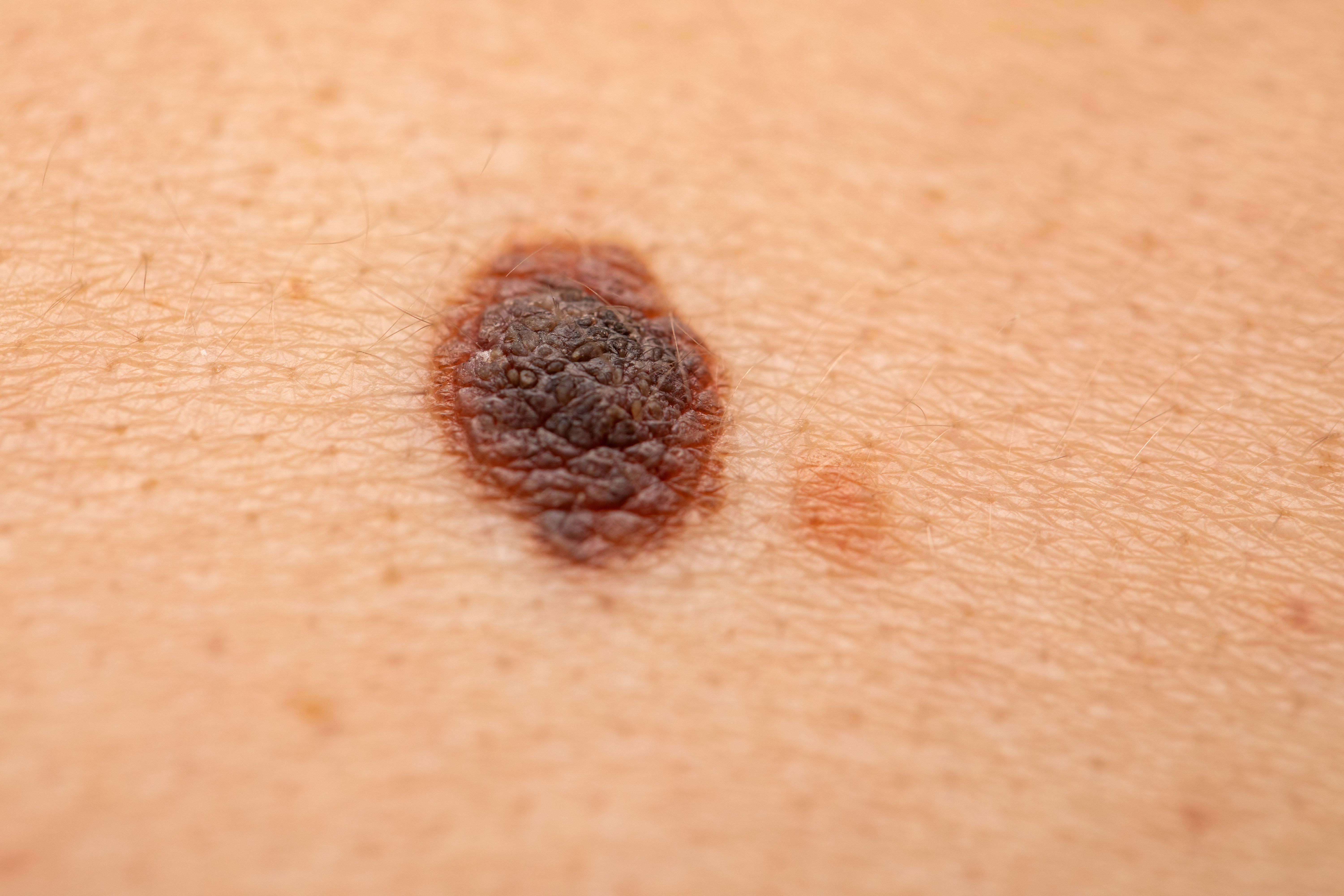 Skin cancer is a dangerous morbidity risk in patients with CLL | image credit: Ocskay Mark - stock.adobe.com